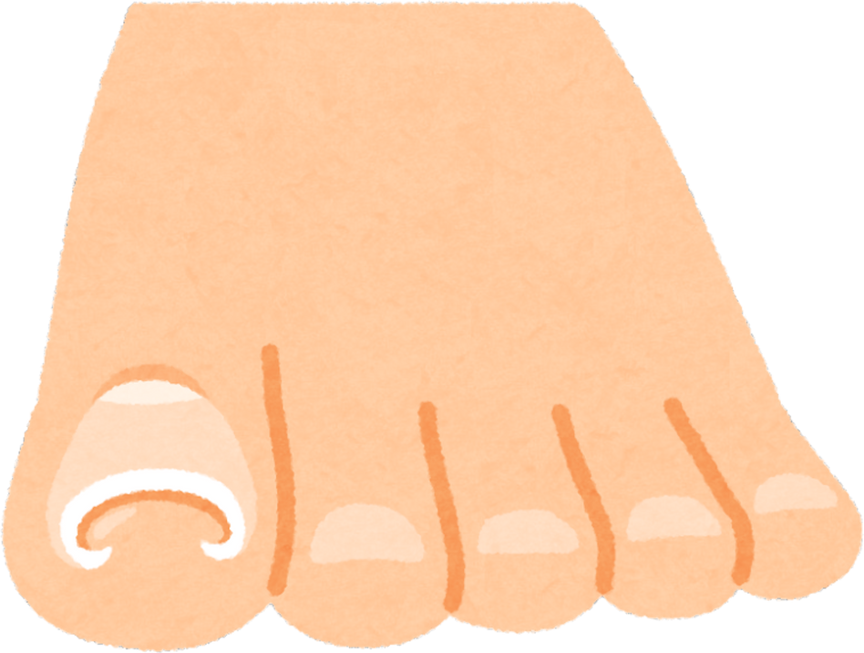 Illustration of an Ingrown Toenail